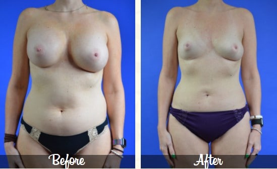 Mommy Makeover Liposuction