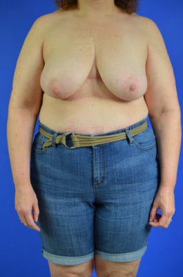 Bilateral Breast Reconstruction stage 1 Before Mastectomy 7136