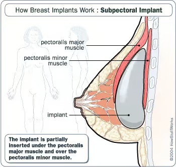 breast augmentation