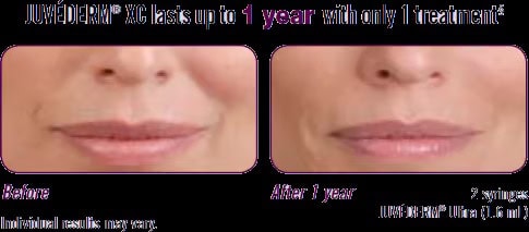 Juvéderm XC®