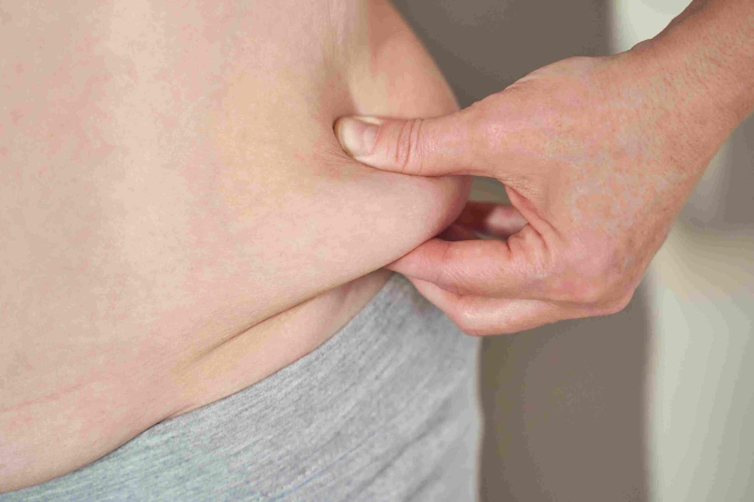 Major weight loss patient considering arm lift, thigh lift, body contouring and excess loose skin removal after weight loss