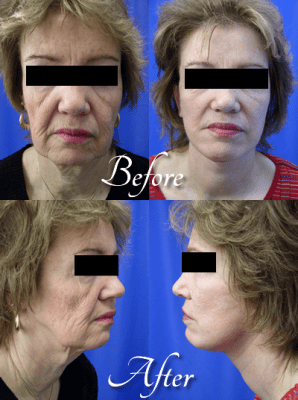 facelift-before-after