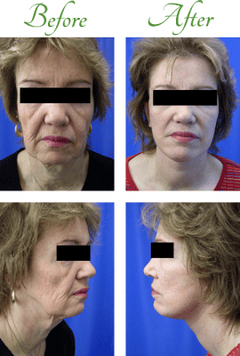 facelift-before-after